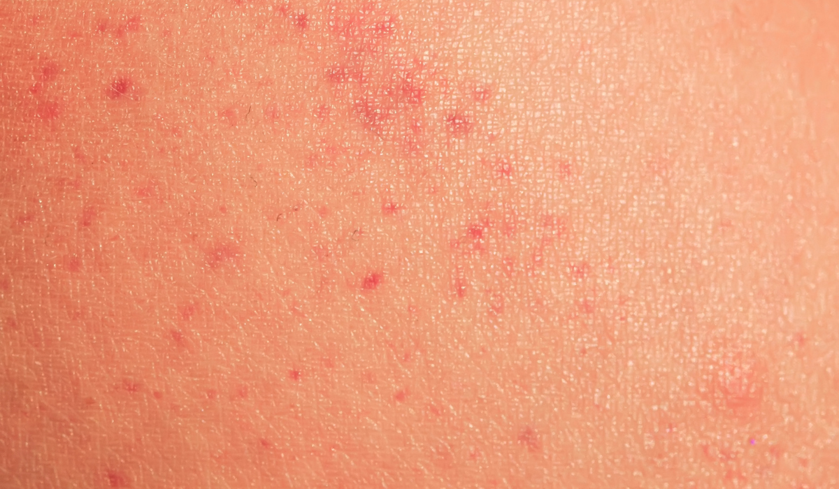 Voltak már rajtad is ilyen viszkető piros foltok? Akkor ennek nem fogsz örülni!