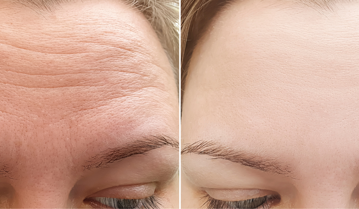 Este Bekened Az Arcod, Majd Reggelre Eltűnnek A Ráncok! Ilyen Egyszerű: